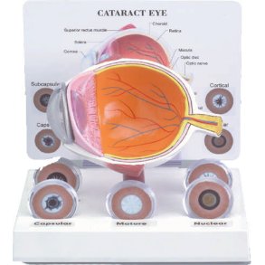 CATARACT EYE MODEL WITH 5 LENSES 6 1/2
