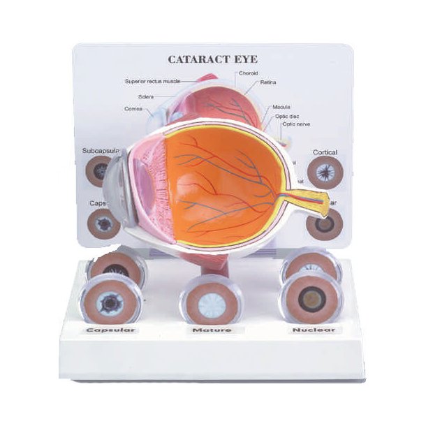 CATARACT EYE MODEL WITH 5 LENSES 6 1/2" X 5"""" BASE DIMENSI"""